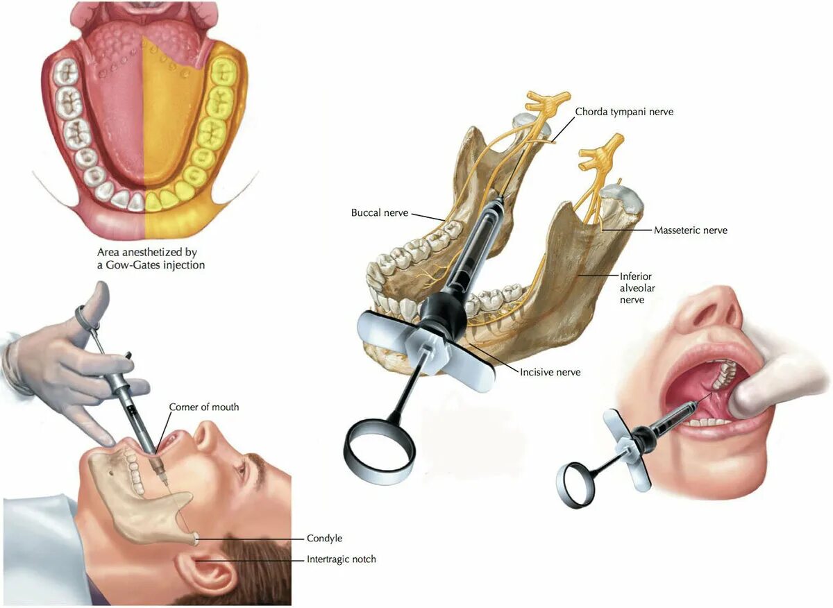 Анестезия по гейтсу. Торусальная анестезия в стоматологии. Торусальная анестезия в стоматологии схема. Проводниковая анестезия мандибулярная. Проводниковая анестезия нижней челюсти торусальная.