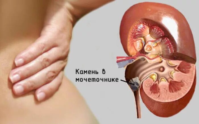 При почечной колике в моче наблюдается
