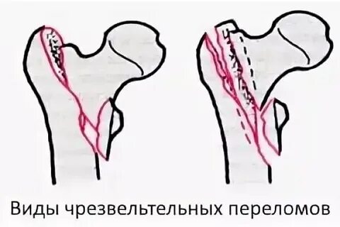 Через сколько операция перелом