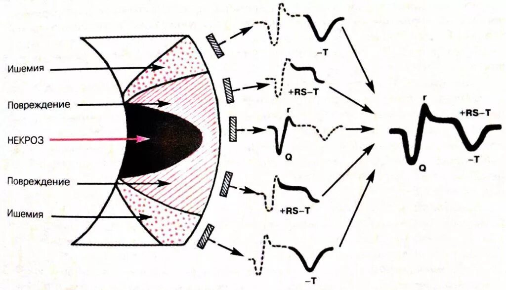 Зона ишемии. Ишемия повреждение некроз на ЭКГ. ЭКГ при ишемии и инфаркта миокарда. Острый крупноочаговый инфаркт миокарда. Зона некроза при инфаркте миокарда.