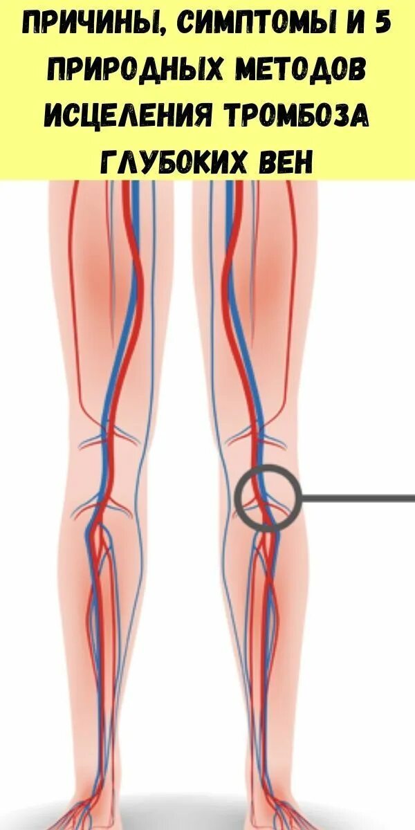 Причины тромбов симптомы. Тромбофлебит вен нижних конечностей. Тромбофлебит нижних конечностей симптомы. Тромбоз глубоких вен конечностей.