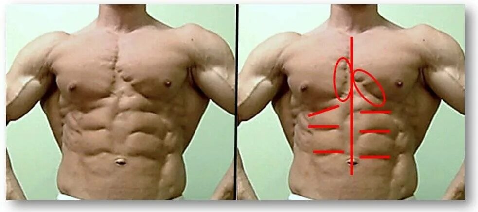 Почему левое больше правого. Несимметричные грудные мышцы. Асимметрия грудных мышц. Диспропорция грудных мышц. Мышечная асимметрия грудных мышц.