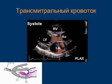Эхокардиография с допплеровским анализом что это
