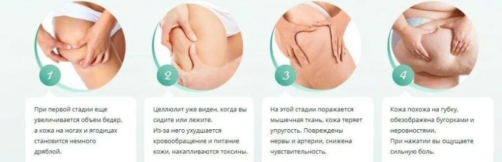 Почему появляется целлюлит. Стадии развития целлюлита. как узнать стадию целлюлита. целлюлит на ранней стадии. как называется 3 стадия целлюлита.