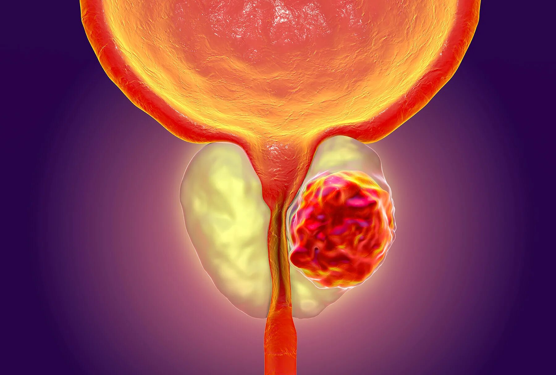 STAGE 4 INOPERABLE CANCER - YouTube