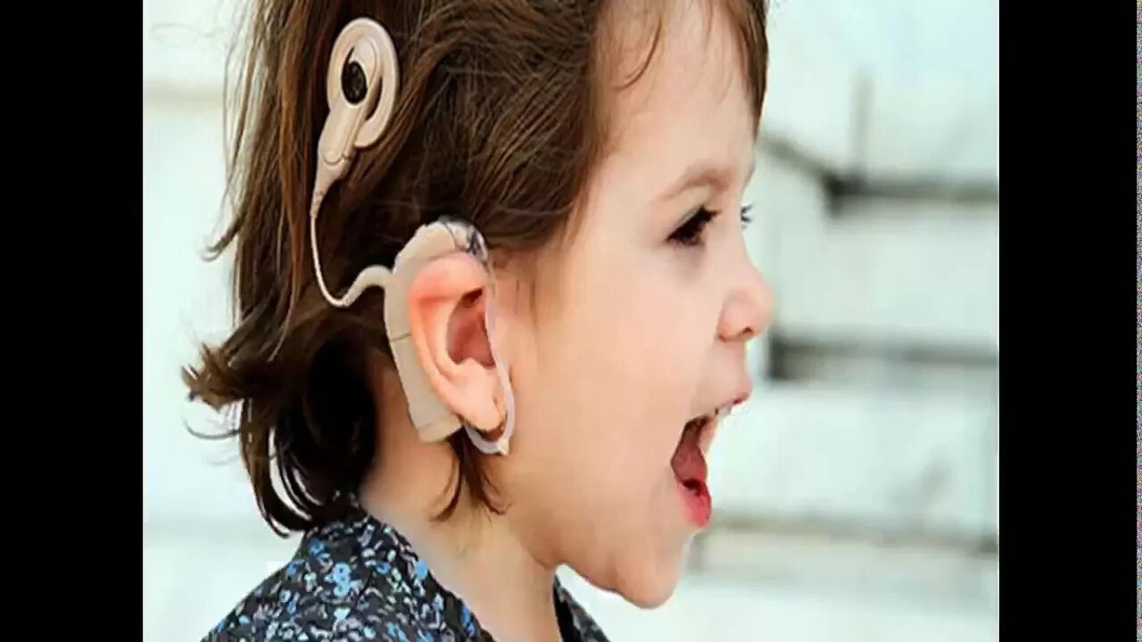 Кохлеарная имплантация Cochlear. Кохлеарный имплант слух. Аппарат для глухих кохлеарная имплантация. Ребенок с кохлеарным имплантом.