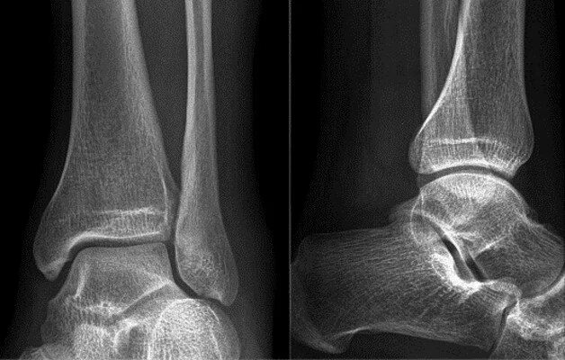 Артроз голеностопного сустава рентген. Голеностоп сустав рентген норма. Голеностопный сустав анатомия артроз. Внутрисуставные переломы голеностопного сустава рентген.