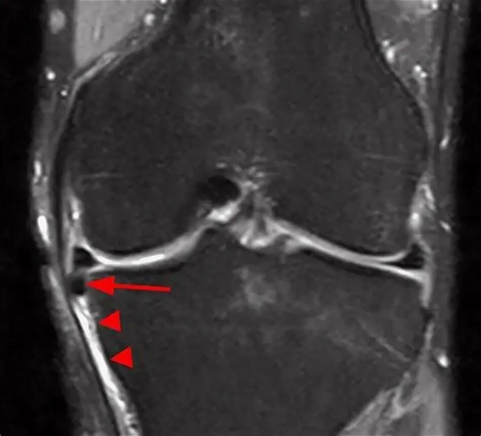 Разрыв коллатеральной связки коленного сустава мрт. Мрт коленного сустава разрыв мениска. Менисцит медиального мениска. Коллатеральные связки коленного сустава мрт.