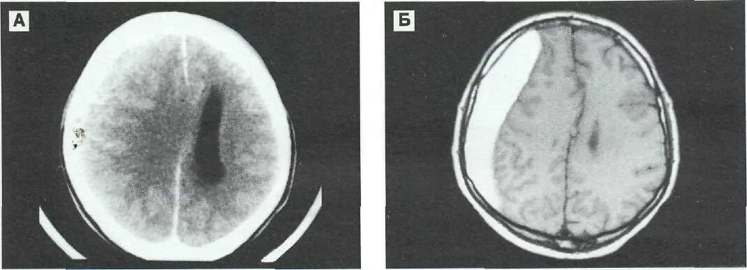 Субдуральное кровоизлияние кт. Субдуральная гематома головного мозга кт. Субдуральная гематома на кт. Субдуральная гематома мрт. Умеренно расширение конвекситальных пространств