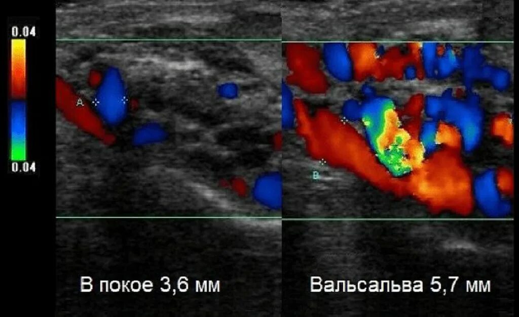 Допплерография варикоцеле. Степени варикоцеле по УЗИ. Степени варикоцеле на УЗИ. Варикоцеле 2 степени на УЗИ. Расширение вены семенного канатика