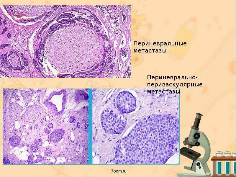 Онкология предстательной железы гистология. Периневральной инвазии опухоли. Периневральная инвазия что это. Периневральная инвазия гистология. Периневральная инвазия что это.