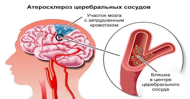 Бляшка в головном мозге