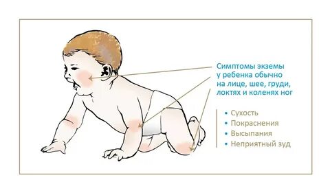 Признаки абкм у грудничка