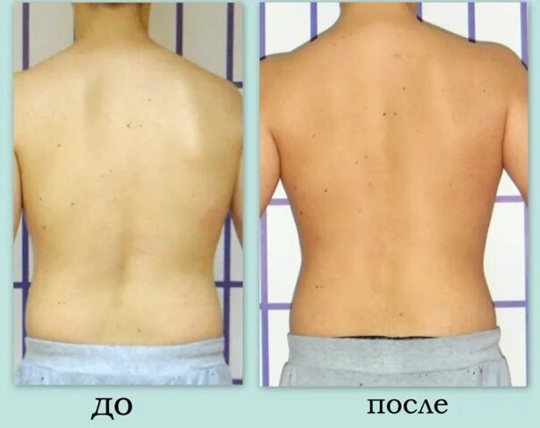 Лфк катарины шрот. Методика катарины шрот при сколиозе. Сколиоз гимнастика по методу катарины шрот. Катарина шрот. Корсет шено и гимнастика шрот.