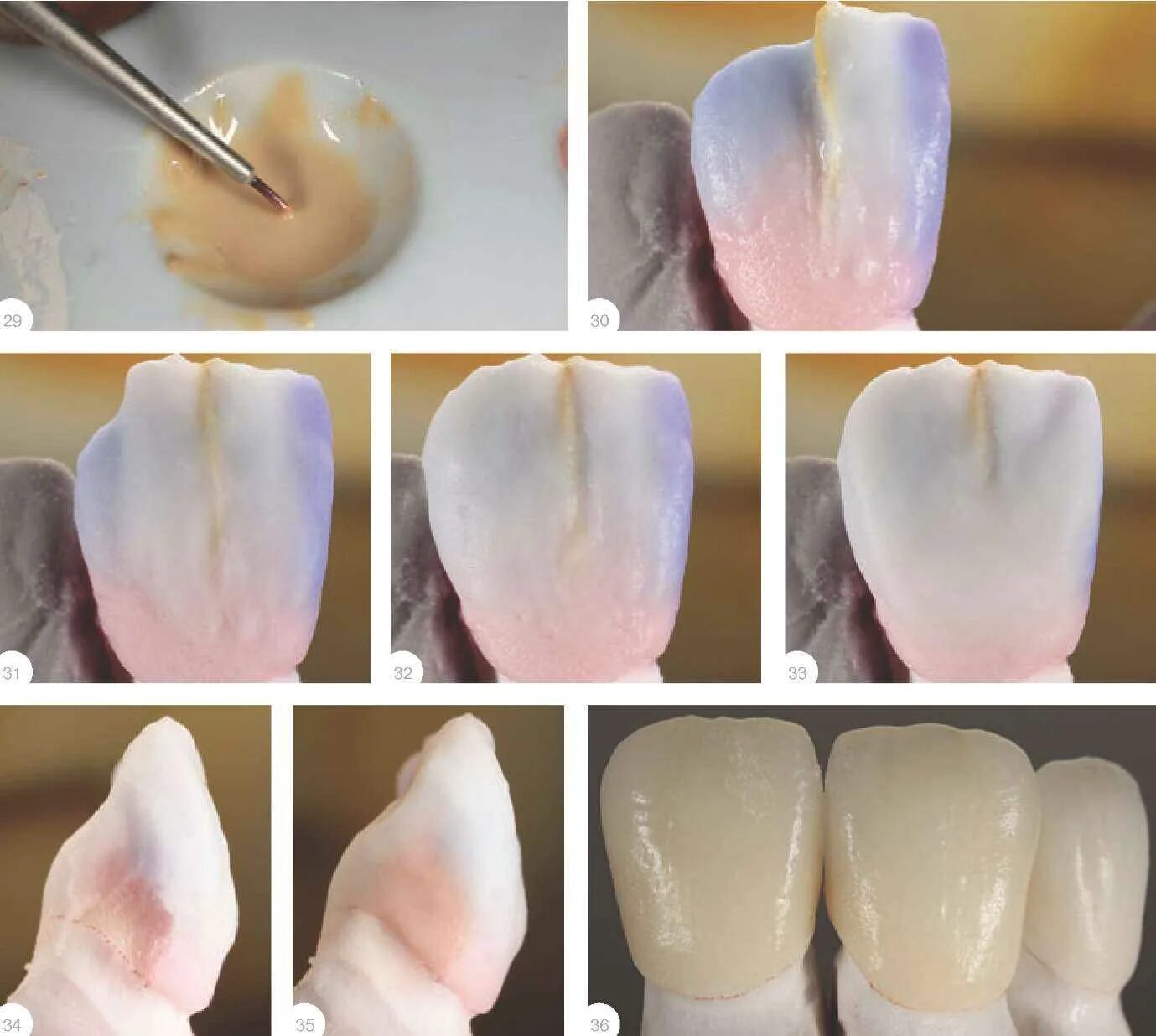 Моделировка Emax коронок. Коронка металлокерамическая масса Noritake. Виниры Emax литники. Коронка Emax премоляр. Лабораторные этапы металлокерамической коронки