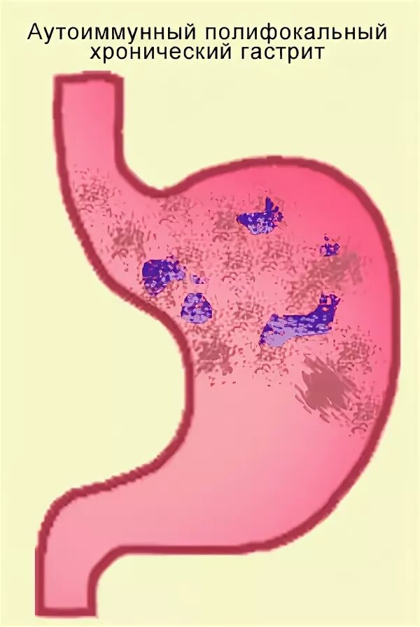Гастрит клин. Аутоиммунный гастрит (гастрит типа а). Аутоиммунный фундальный гастрит. Аутоиммунный фундальный атрофический гастрит. Хронический атрофический гастрит типа а.