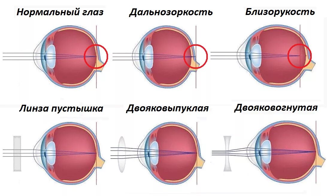 Близорукость первая помощь. Дальнозоркость и близорукость строение глаза. Строение глаза при миопии. Близорукость строение глаза. Строение глаза при близорукости и дальнозоркости.