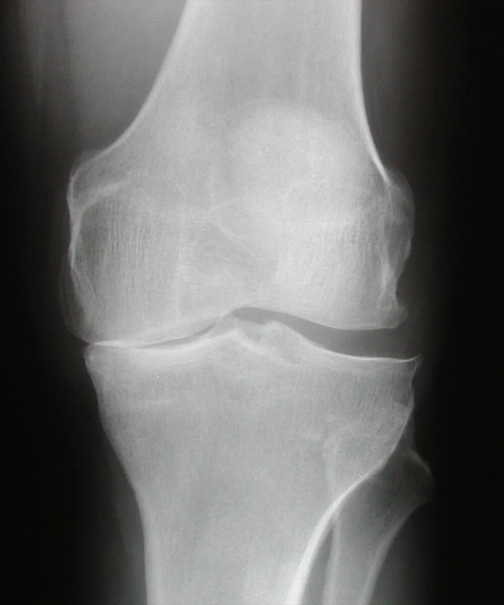 Остеоартроз 1 2 степени коленного сустава. Гонартроз коленного рентген. Гонартроз коленного сустава рентген. Гонартроз коленного сустава 2 стадии рентген.