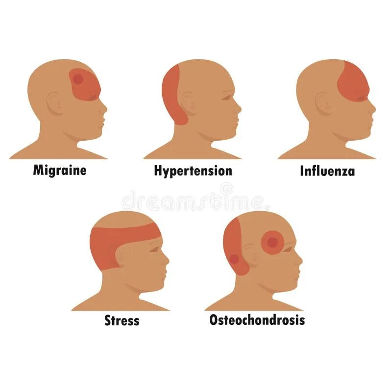 Коитальная цефалгия. Головная боль схематически. Схематическое изображение головной боли. Локализация боли в голове. Очаги боли в голове.