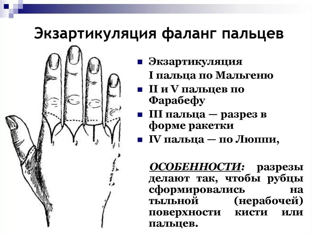 Гангрена карта вызова. Ампутация и экзартикуляция фаланг и пальцев кисти. Экзартикуляция пальца по Люппи. Техника ампутации и экзартикуляции фаланг пальцев. Экзартикуляция в межфаланговом сочленении.