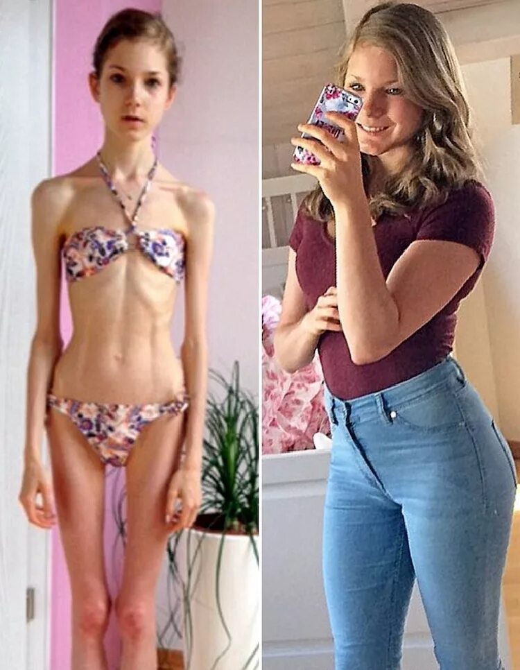 Девушки после анорексии. Худые девушки. Девушки до и после анорексии.