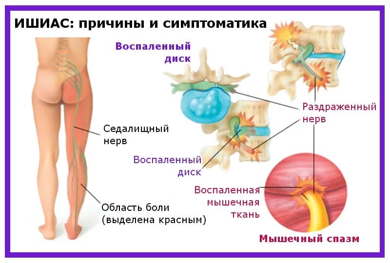 Какое лечение при защемлении