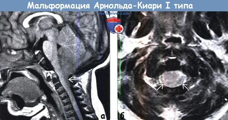 Аномалия арнольда. Аномалия арнольда киари мрт. аномалия арнольда киари на кт.