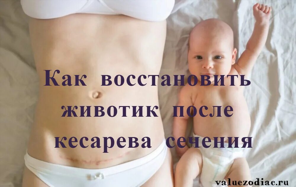 Как быстро восстановиться после кесарева сечения. Живот после кесарева сечения. живот после кесарево сечения. восстановить живот после кесарева.