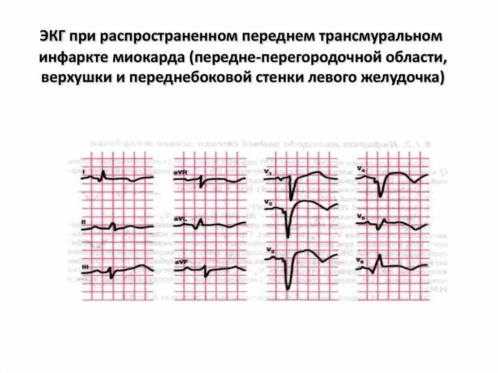 Изменение миокарда передне перегородочной области. Трансмуральный инфаркт миокарда на ЭКГ. ЭКГ передне перегородочный инфаркт миокарда левого желудочка. Инфаркт миокарда трансмуральный перегородочный. Трансмуральный инфаркт на ЭКГ.