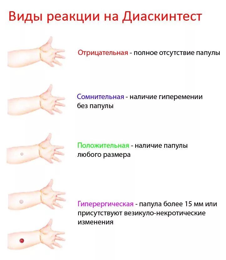 Прививка после манту через какое время. Оценка результатов диаскинтест норма. Папула положительный диаскинтест. Прививка диаскинтест норма. Прививка реакция диаскинтест.