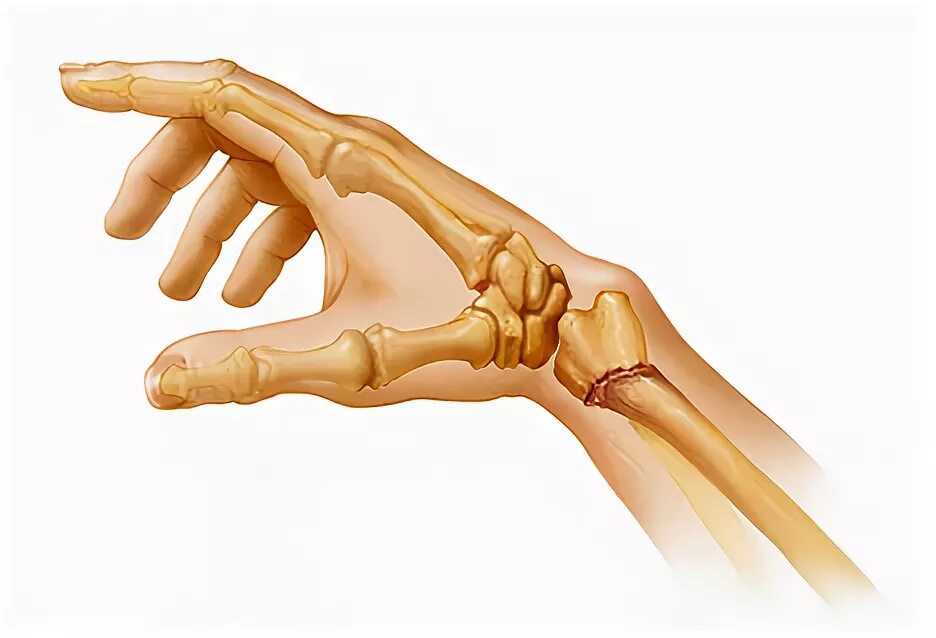 Перелом лучевой кости кисти. Лучевая кость кисти перелом запястья. Перелом руки в лучезапястном суставе. Перелом лучевой запястной кости.