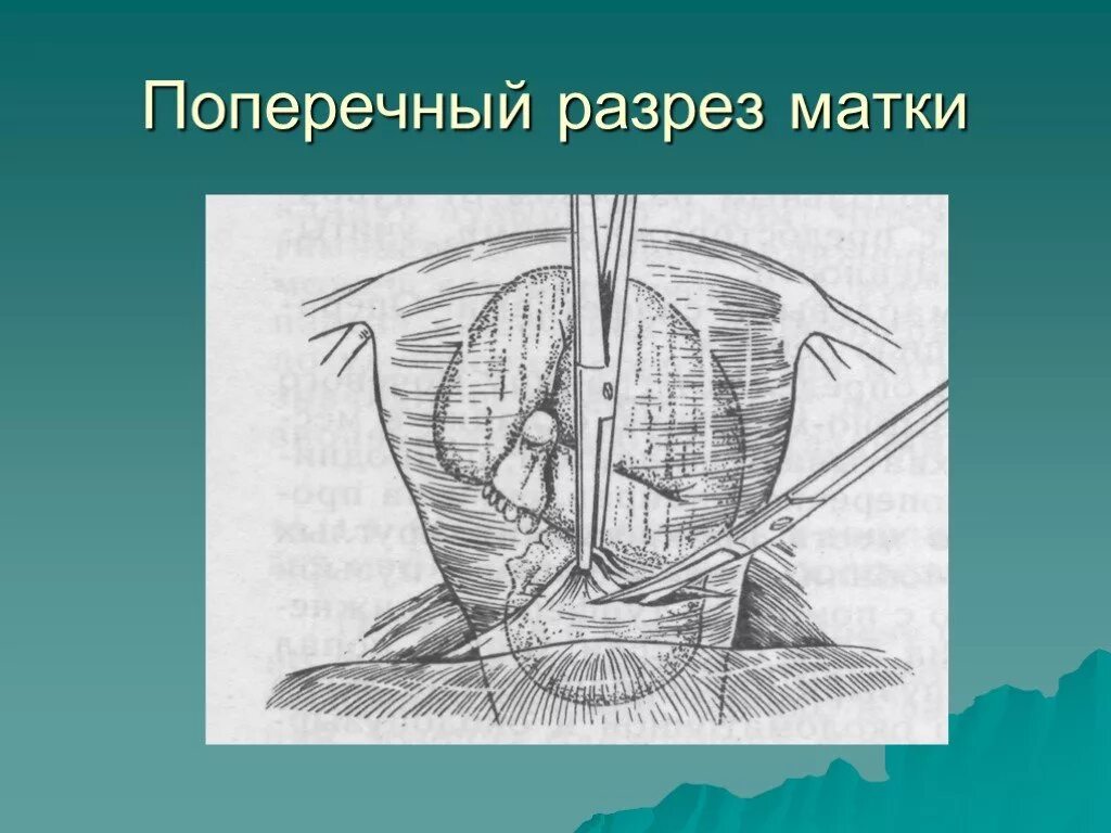 Кесеровое сечение. Пфанненштилю лапаротомия. Нижнесрединная лапаротомия. Лапаротомия кесарево сечение. Поперечный разрез Кесар.