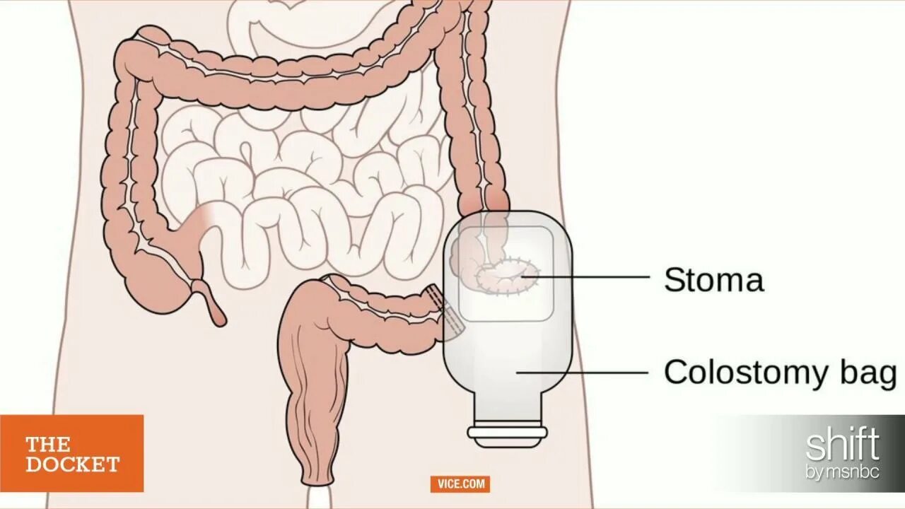 Колостома толстой кишки. Стома операция толстой кишки. Проксимальная колостома. Колостома Толстого кишечника. Как восстановить кишечник после операции