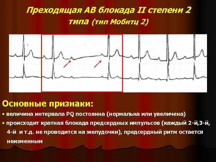 Диагноз АВ блокада 2 степени. АВ блокада 2 степени 3 Тип. АВ блокада 2 типа транзиторная блокада степени 1. АВ блокада 2 степени Мобитц 1 на ЭКГ.