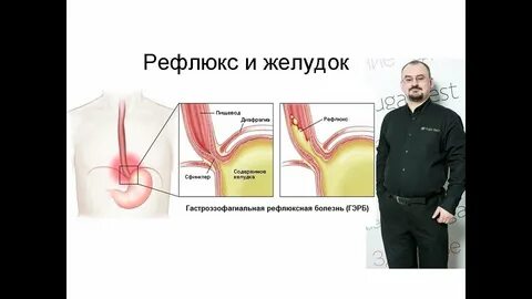Рефлюкс эзофагит дуодено гастральный рефлюкс