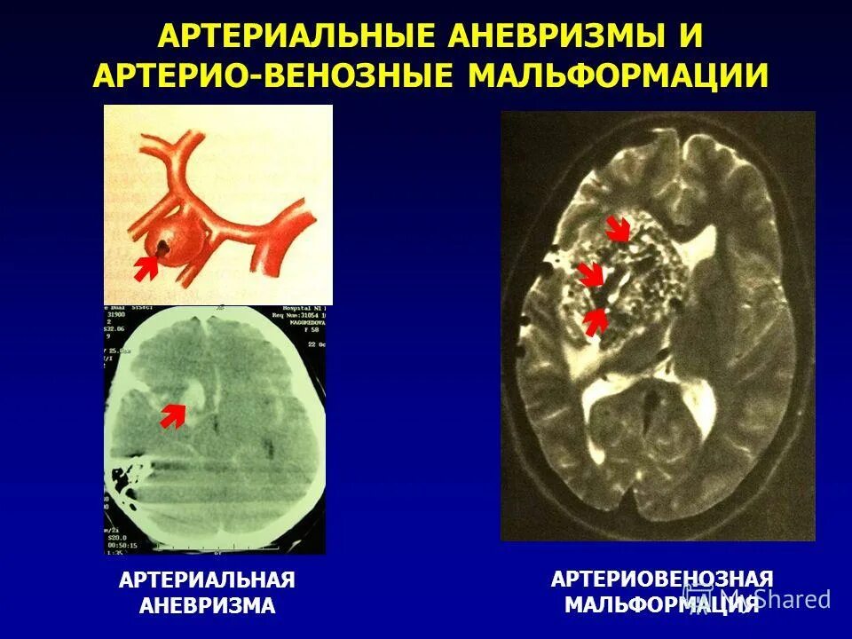 Аневризма к какому врачу обращаться. Артериовенозная мальформация артерии. аневризма мальформация сосудов головного мозга. артериовенозная мальформация этиология. артериовенозная мальформация брюшной полости.