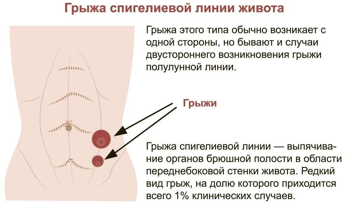 Симптомы грыжи живота у женщин слева