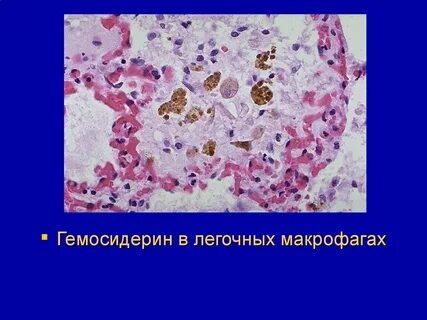 Макрофаги с гемосидерином