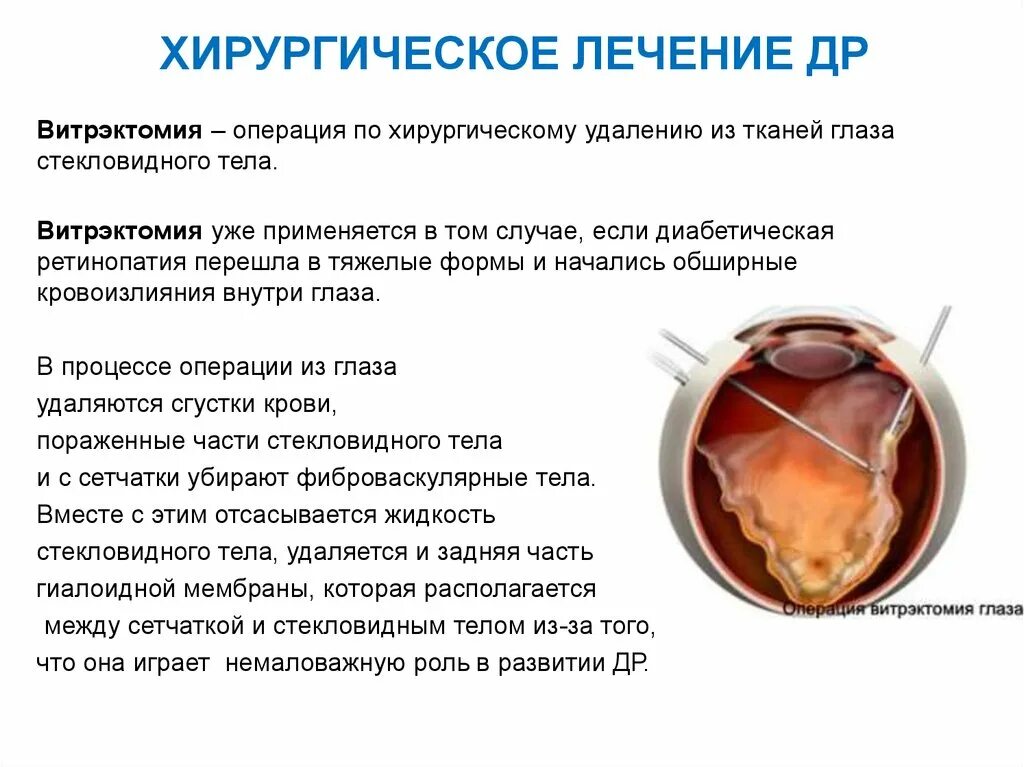 Витрэктомия при диабетической ретинопатии. Диабетическая ретинопатия глаз. Микроинвазивная витрэктомия. Стекловидное тело операция