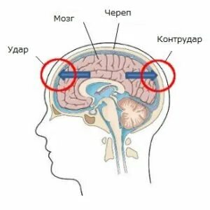 Как понять сотрясение или нет