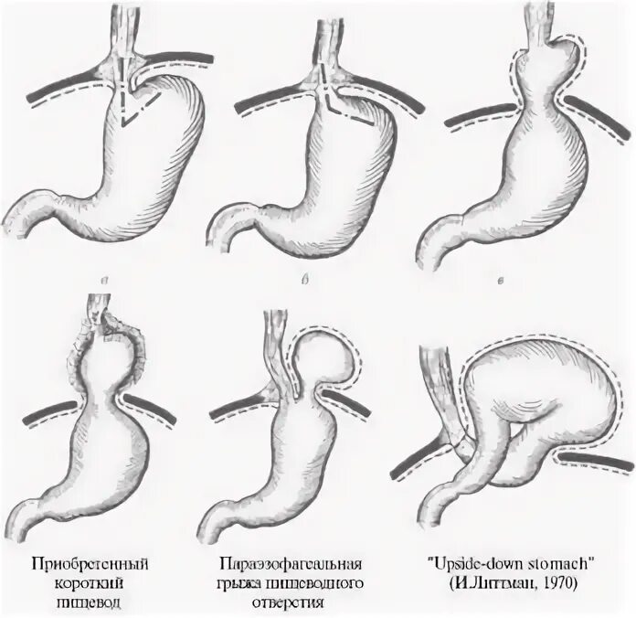 Скользящая грыжа под