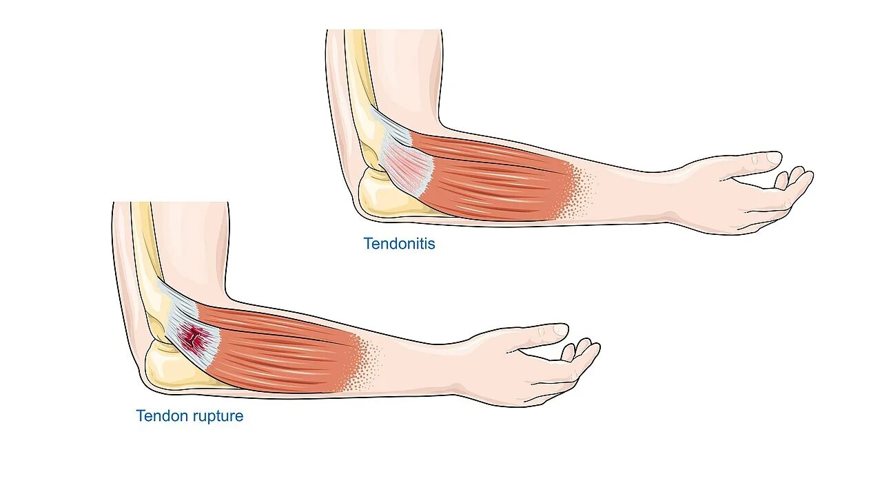 Почему болят локтевые сгибы. Локоть теннисиста латеральный эпикондилит. Тендинопатия сухожилия локтевого сустава. Надмыщелок локтевого сустава. Тендинит двуглавой мышцы локтя.