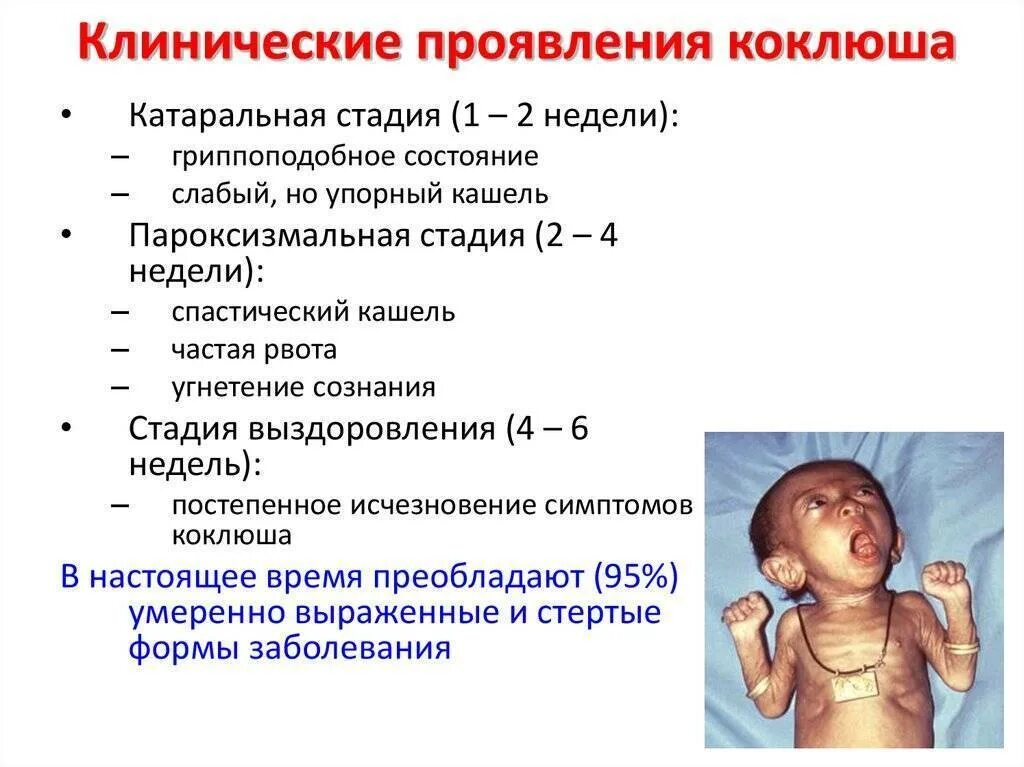 Последствия болезни коклюшем. Коклюш характерные клинические проявления заболевания. Характерные клинические симптомы коклюша. Коклюш специфические симптомы. Коклюш симптомы у детей 1 год 3 месяца.