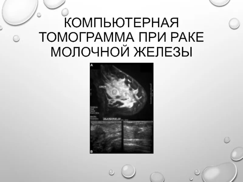 Делают ли кт молочных желез. Кт при онкологии молочной железы. опухоль молочной железы на кт.