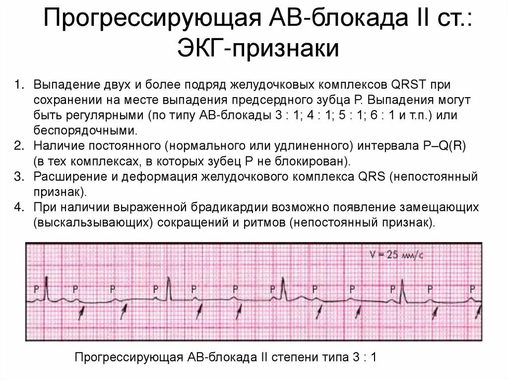 Атриовентрикулярная блокада признаки. АВ блокада 2 типа транзиторная блокада степени 1. АВ блокада 2 степени Тип 1 ЭКГ признаки. АВ блокада 3 ст на ЭКГ. АВ блокада 2 степени 1 типа 3:1.