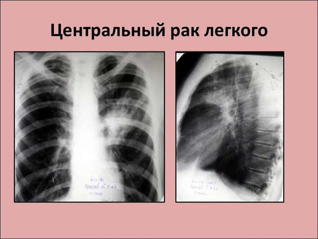 Центральное образование легкого рентген. Опухоль легкого на рентгене. Центральное CR левого легкого. Опухоль в легких на рентгене. Диффузный рак легких