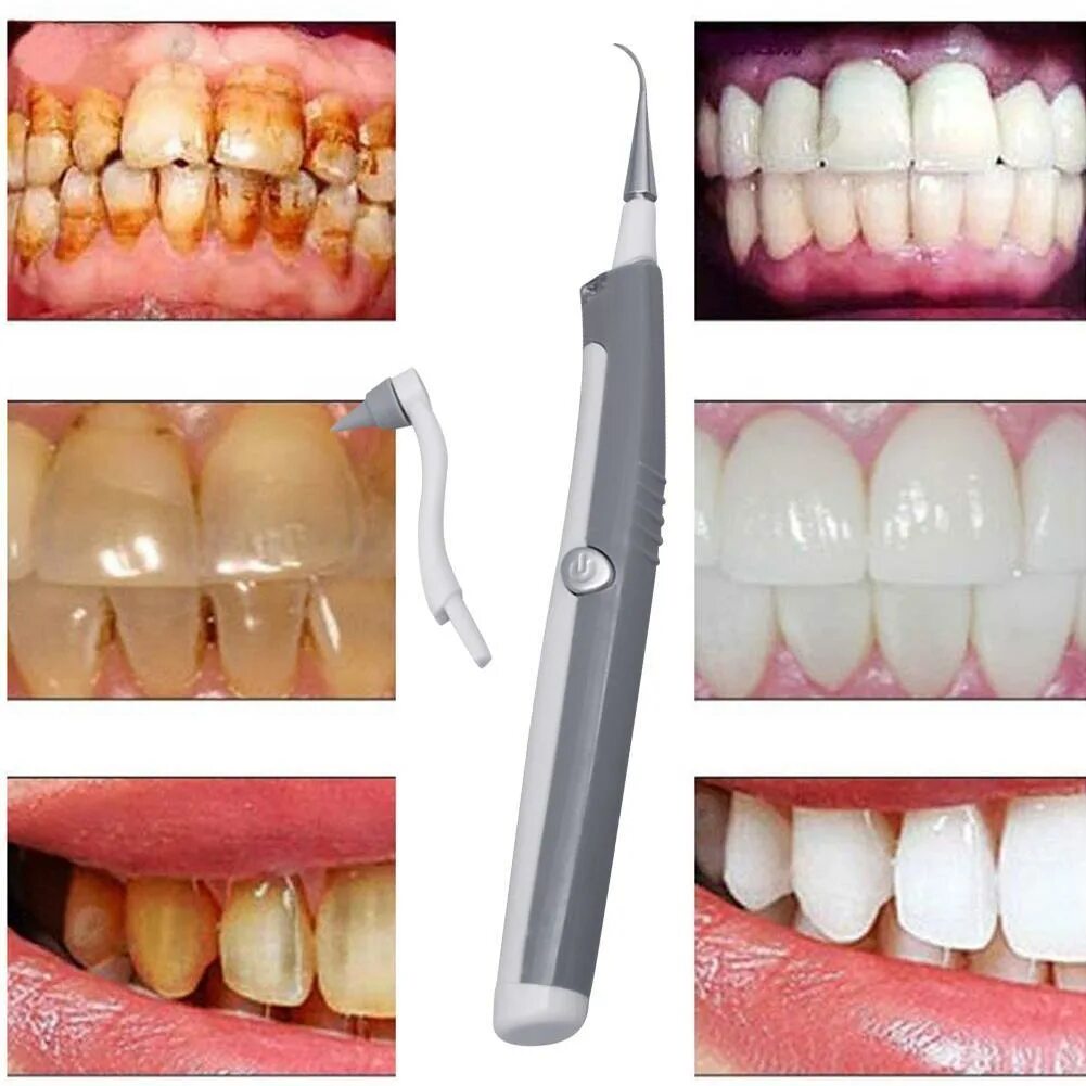 пришеечный зубной камень. чистка зубов ультразвуком. зубной какамекакамень. профгигиена полости рта air flow. ультразвуковая чистка зубного камня air flow.