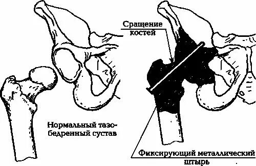 Боли при некрозе тазобедренных суставов. Артродез тазобедренного сустава. операция артродеза тазобедренного сустава.. артродез тазобедренного сустава показания. туннелизация тазобедренного сустава при некрозе.