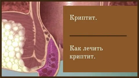 Криптит прямой кишки симптомы и лечение