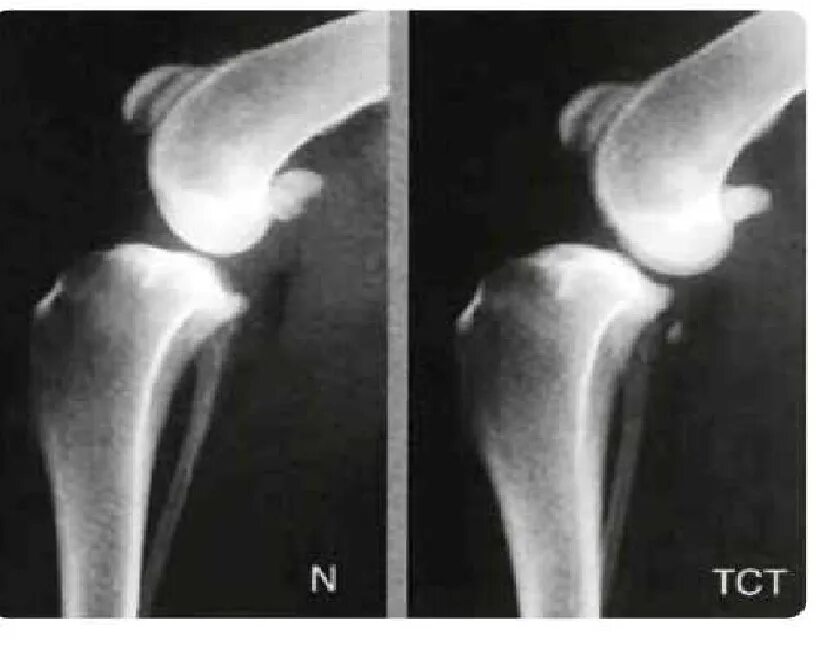 Авульсия шероховатости большеберцовой кости. Отрыв большеберцовой кости. Авульсия гребня большеберцовой кости. Рентген коленного сустава ПКС.